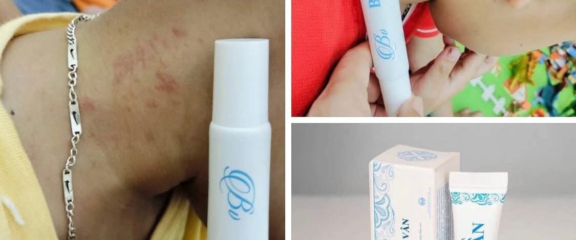 Viêm da cơ địa ở trẻ em: Dấu hiệu và phương pháp điều trị