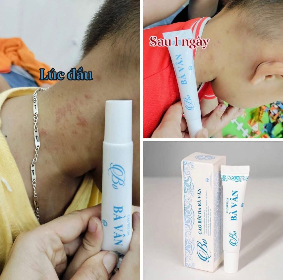 Viêm da cơ địa ở trẻ em: Dấu hiệu và phương pháp điều trị