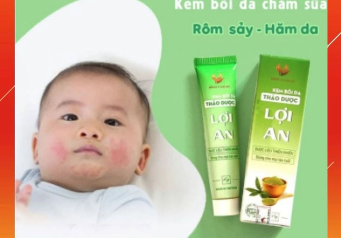 Kem bôi da Lợi An có tác dụng gì? Công dụng và cách dùng an toàn cho trẻ nhỏ